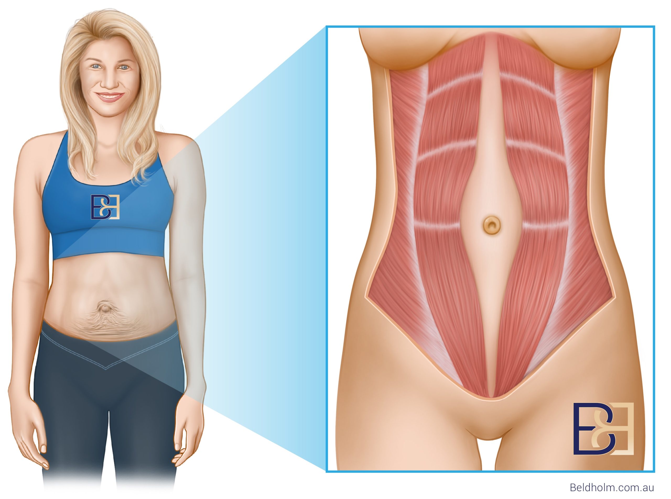 An educational illustration explaining diastasis recti and its effects on abdominal muscles.