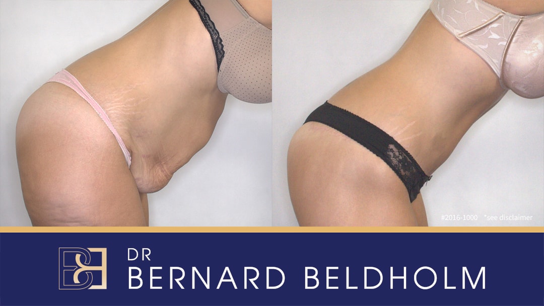 Extended abdominoplasty post significant weight loss performed by Dr Beldholm