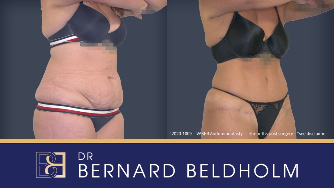 loose skin and sagging in the abdominal area after pregnancyn treated with abdominoplasty by Dr Beldholm