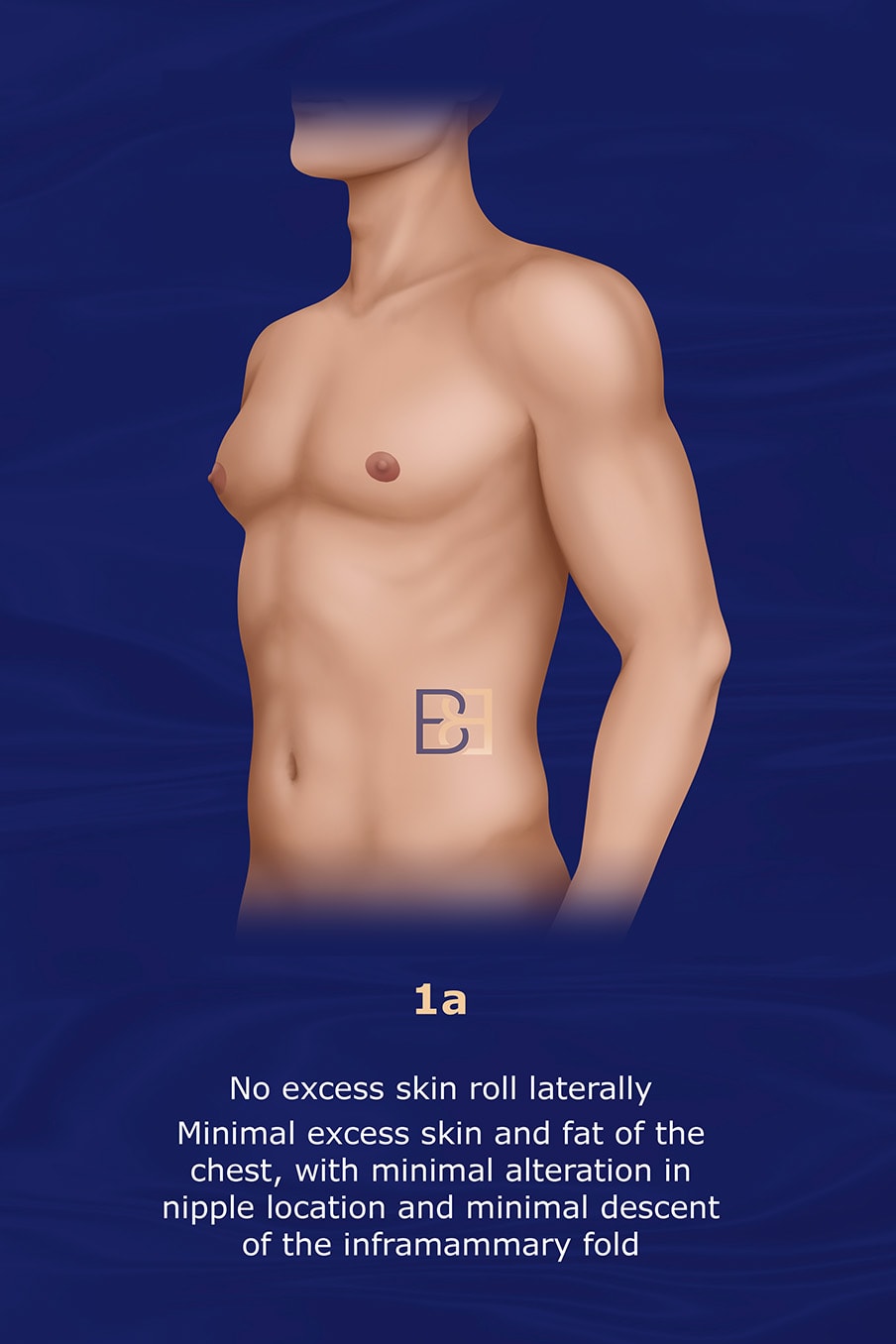 Grade 1a Gusenoff Gynaecomastia Classification System