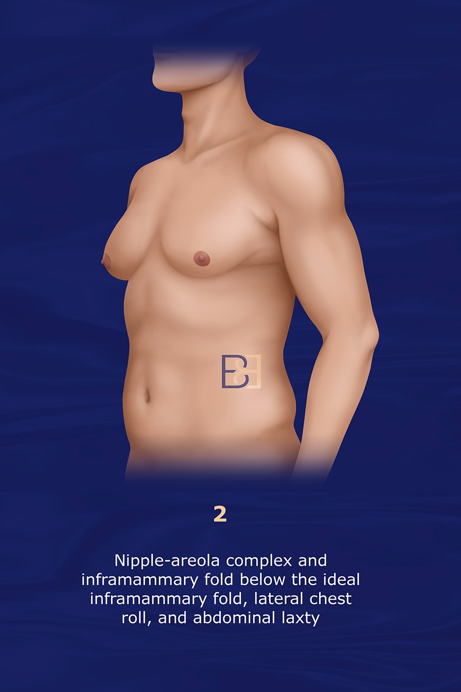 Grade 2 Gusenoff Gynaecomastia Classification System