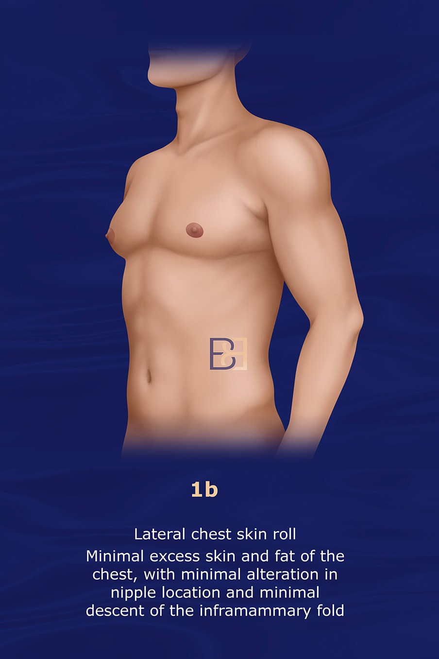 Grade 1b Gusenoff Gynaecomastia Classification System