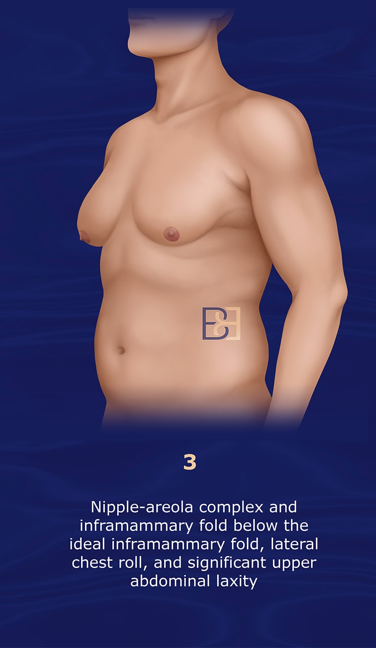 Grade 3 Gusenoff Gynaecomastia Classification System