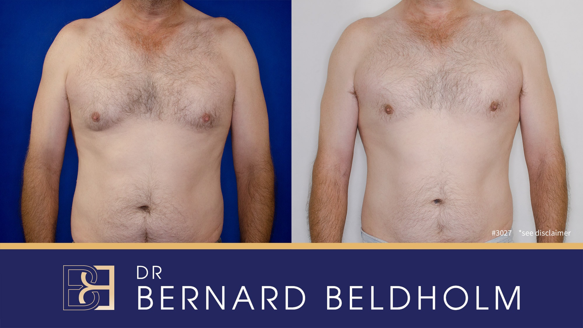 Before and after results. Operation performed by Dr Beldholm