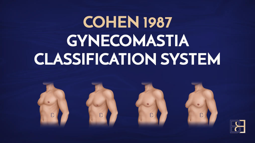 Cohen 1987 Gynaecomastia Classification System