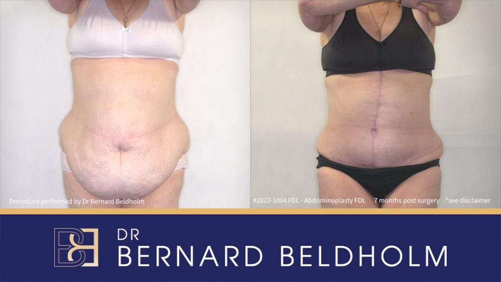 Patient 2022-1004 -Fleur de Lis Abdominoplasty with VASER Liposuction - Front