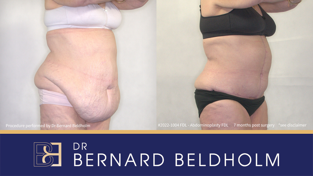 Patient 2022-1004 -Fleur de Lis Abdominoplasty with VASER Liposuction - Left