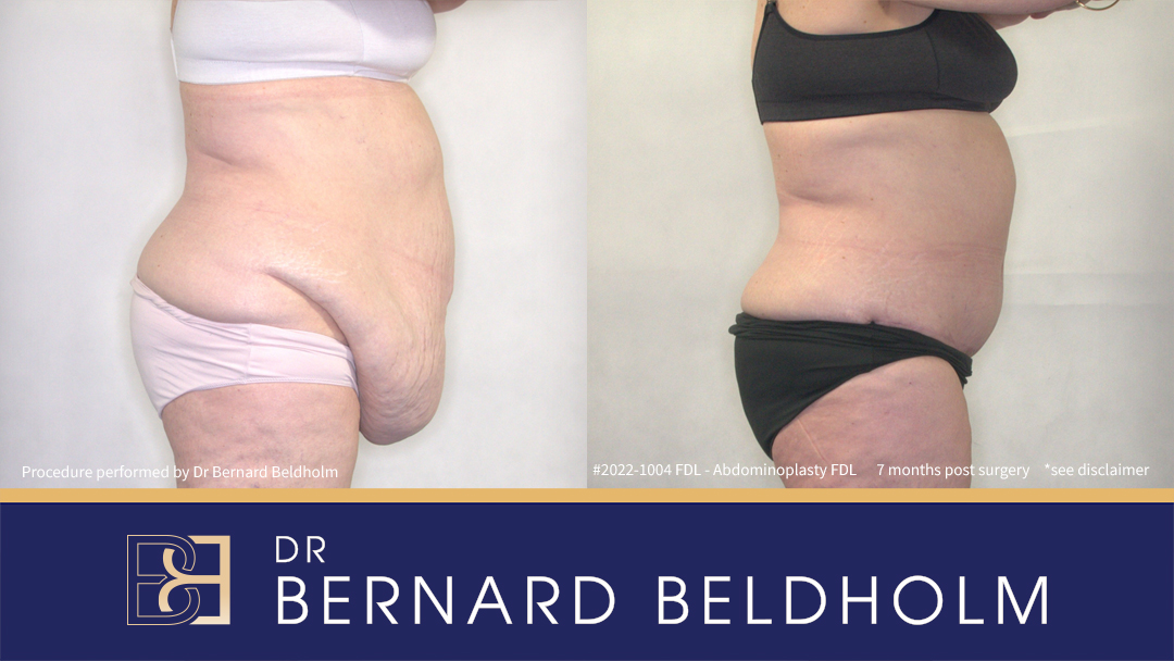 Patient 2022-1004 -Fleur de Lis Abdominoplasty with VASER Liposuction - Side