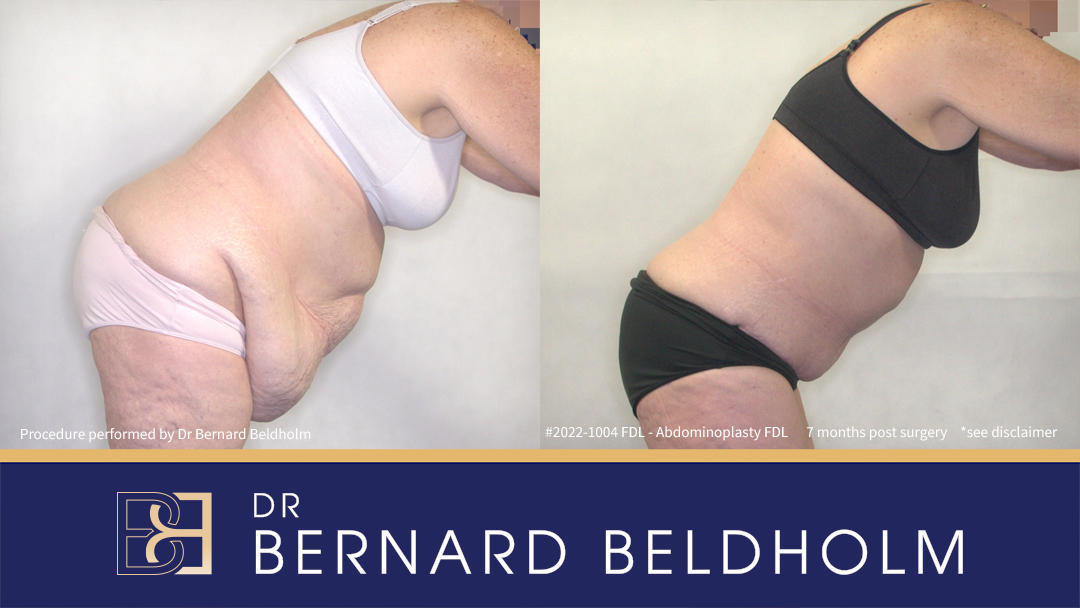 Patient 2022-1004 -Fleur de Lis Abdominoplasty with VASER Liposuction - Bend