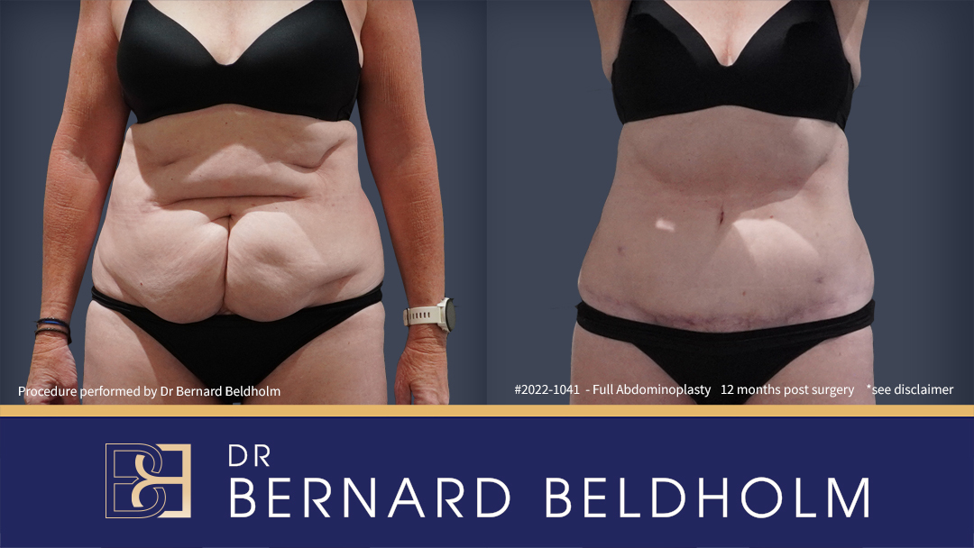 Patient 2022-1041 - Full Tummy Tuck - Before & After