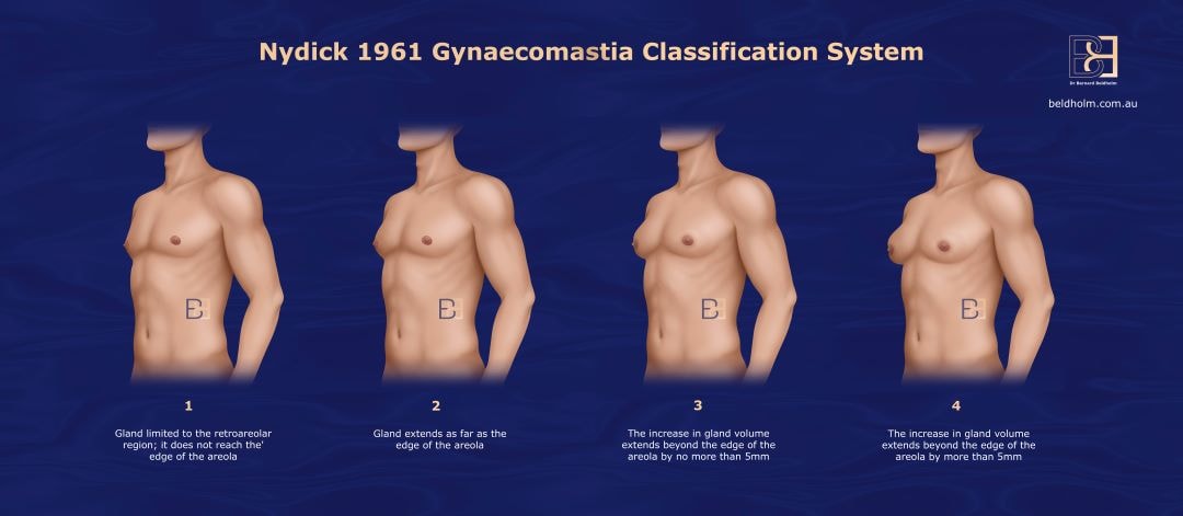 Nydick gynaecomastia grading system