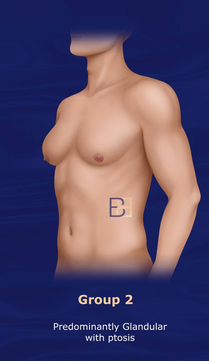 Group 2: Cohen 1987 Gynaecomastia Classification System