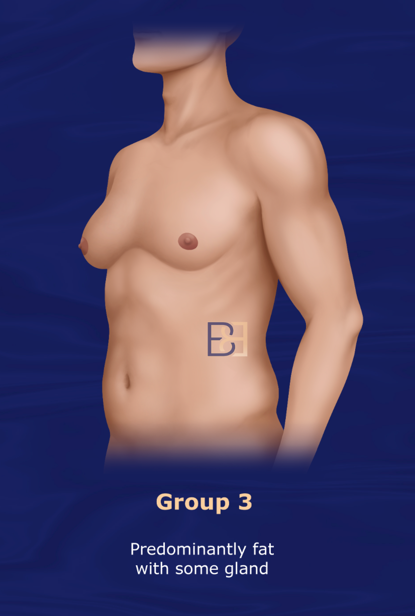 Group 3: Cohen 1987 Gynaecomastia Classification System