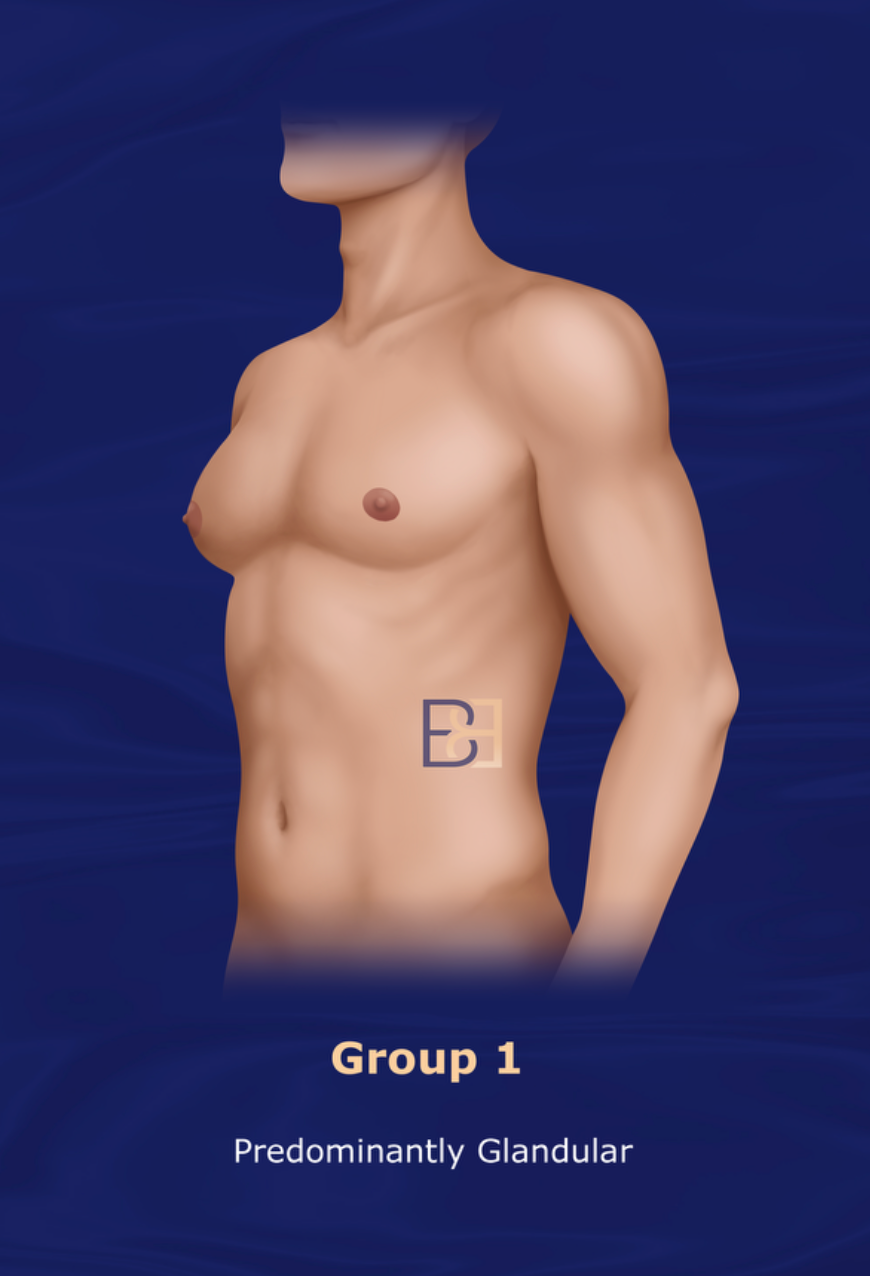 Group 1: Cohen 1987 Gynaecomastia Classification System