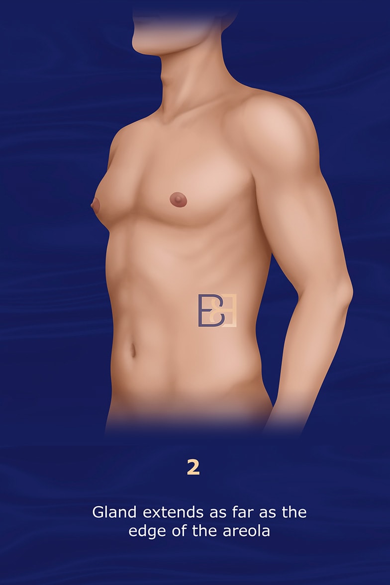 Nydick Gynecomastia Classification System grade 2