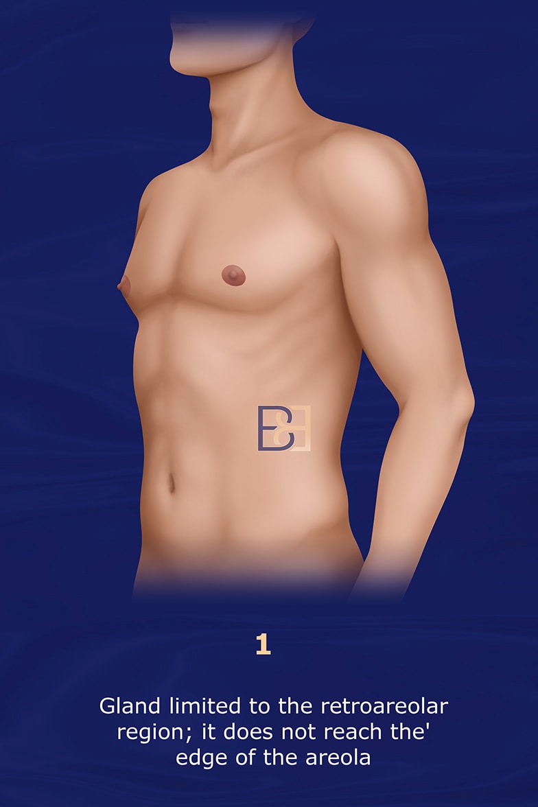 Nydick Gynecomastia Classification System grade 1