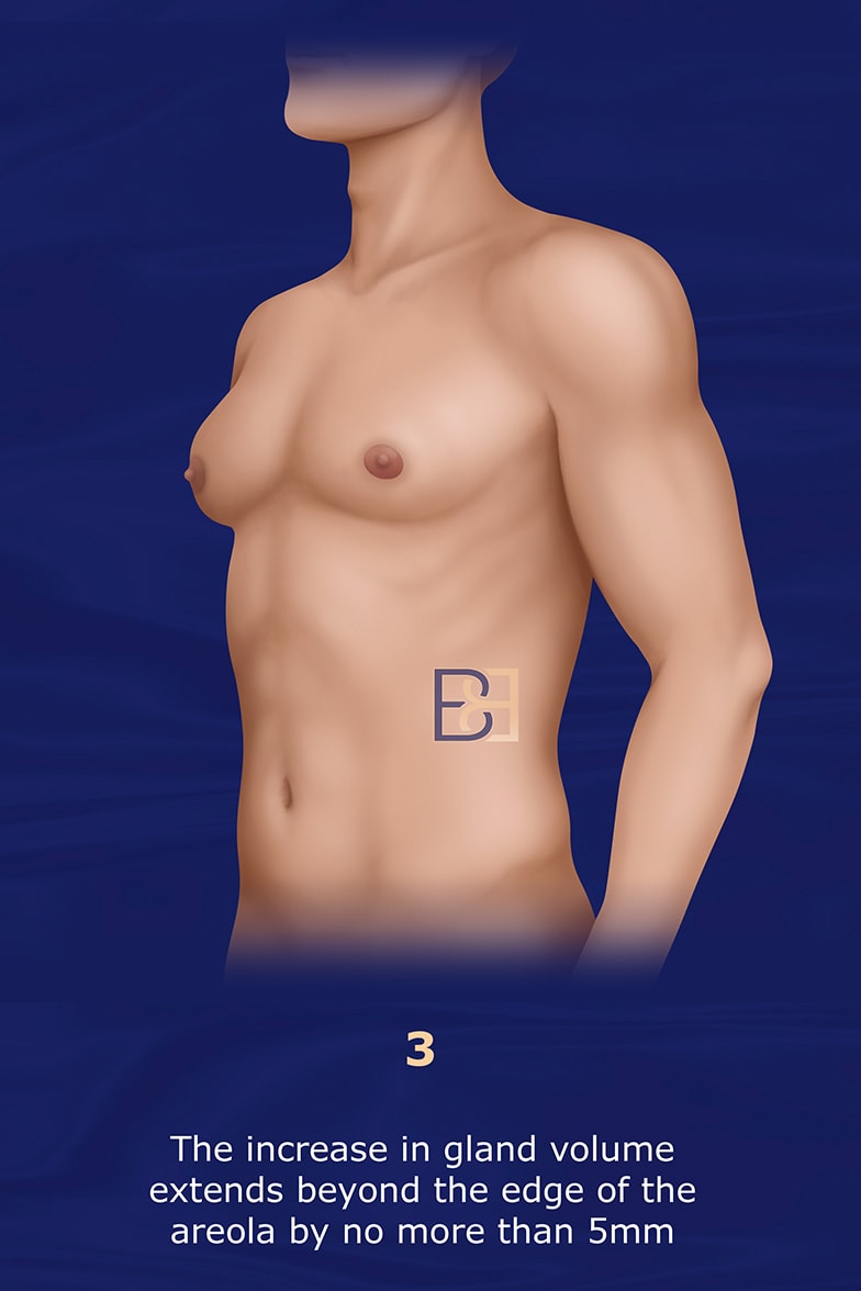 Nydick Gynecomastia Classification System grade 3