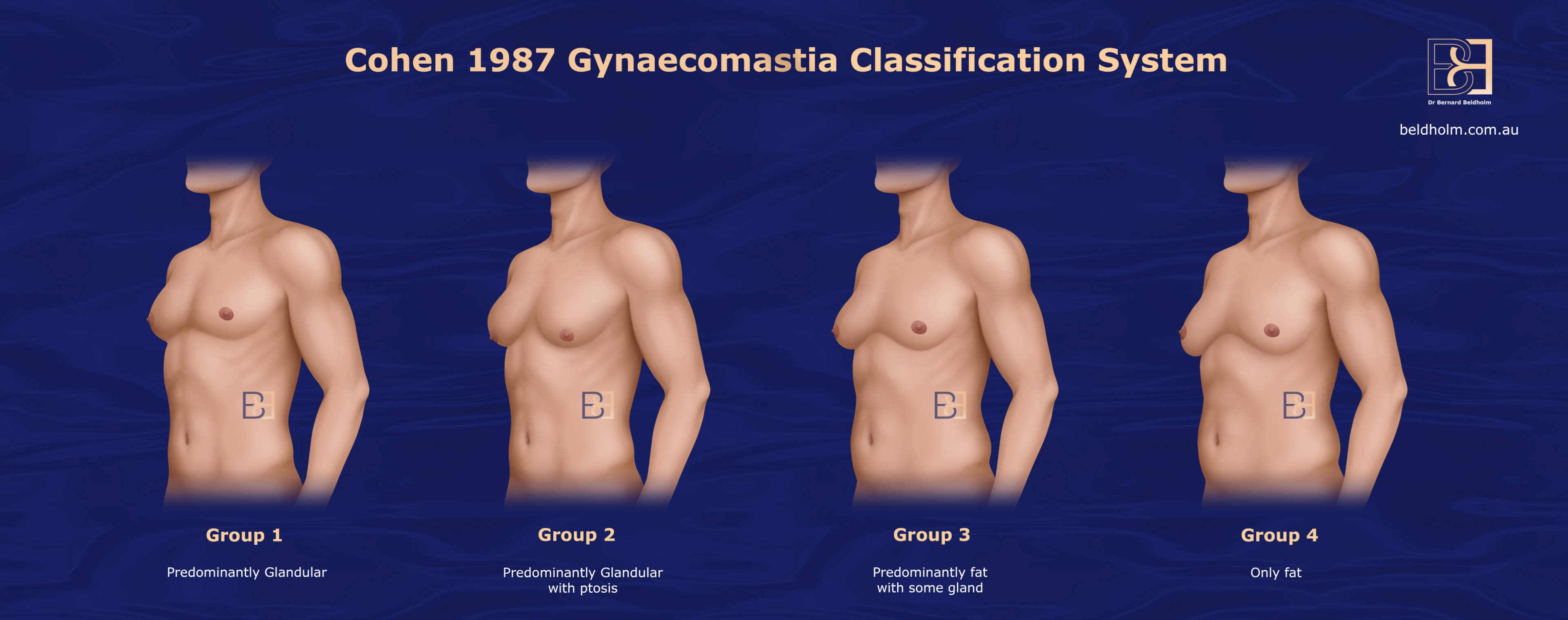 Illustration of the Cohen 1987 Gynaecomastia Classification System | Dr Bernard Beldholm