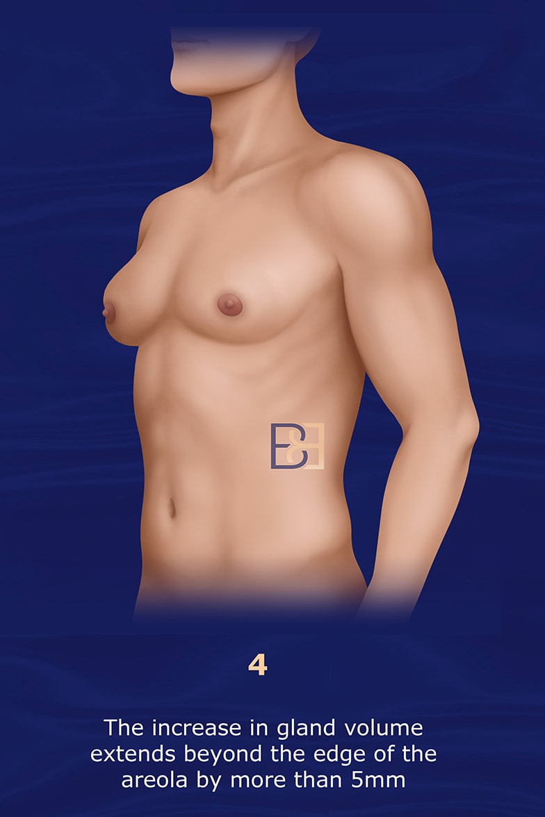 Nydick Gynecomastia Classification System grade 4