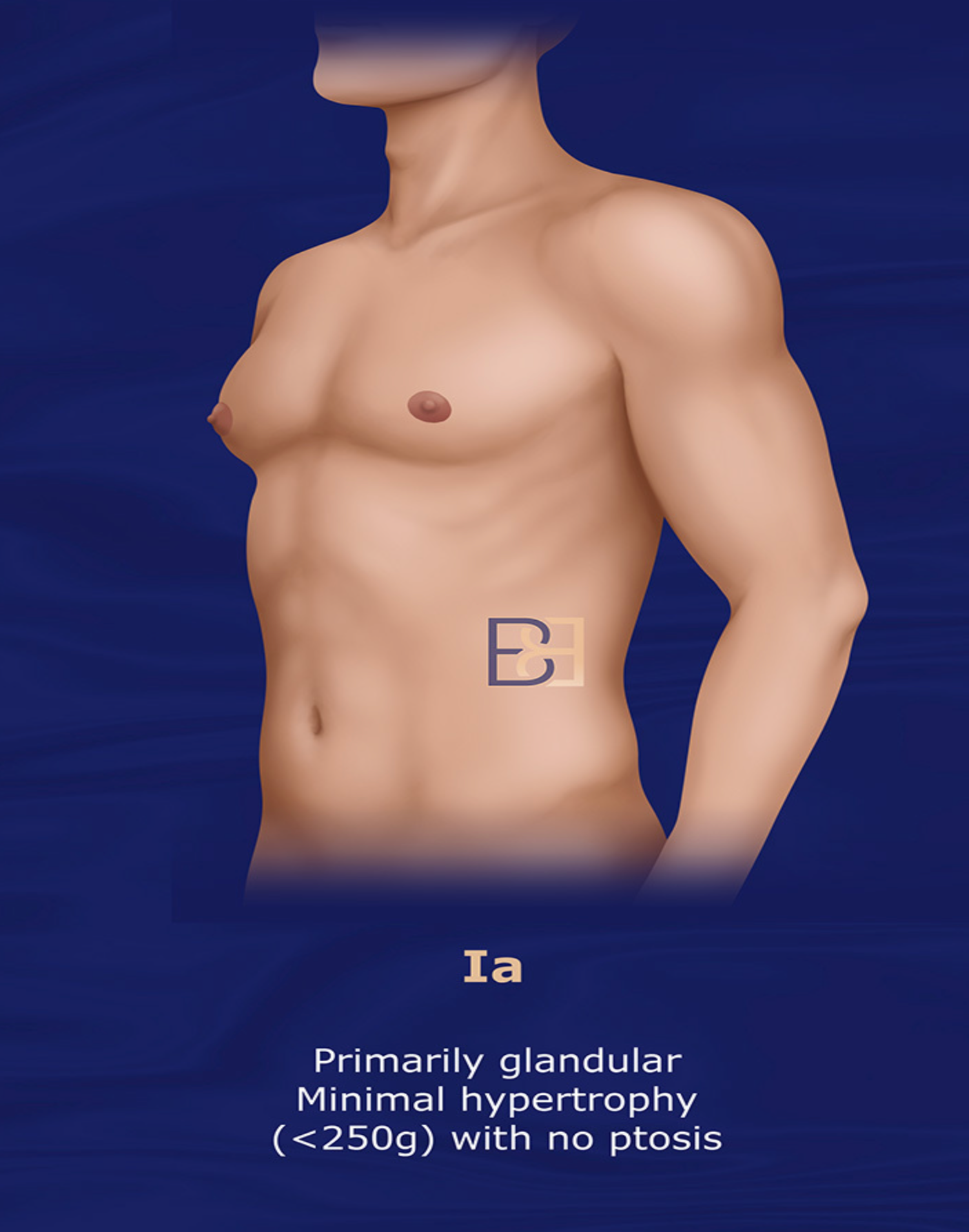 Grade Ia | Rohrich 2003 Gynaecomastia Classification System | Dr Beldholm