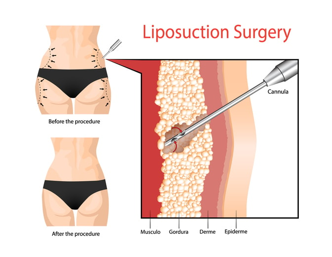 Fat removal with liposuction