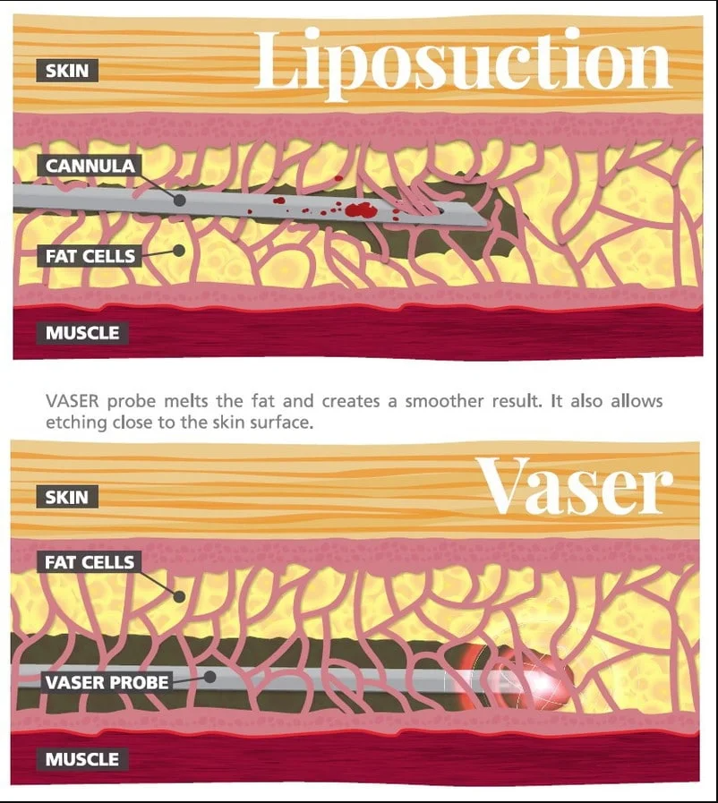 VASER liposuction | Ultrasound-Assisted Liposuction