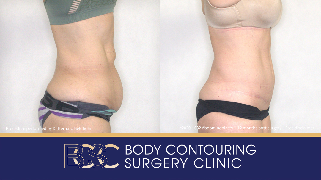 Abdominoplasty Post Weight Loss (Patient 2020-1032) - Side