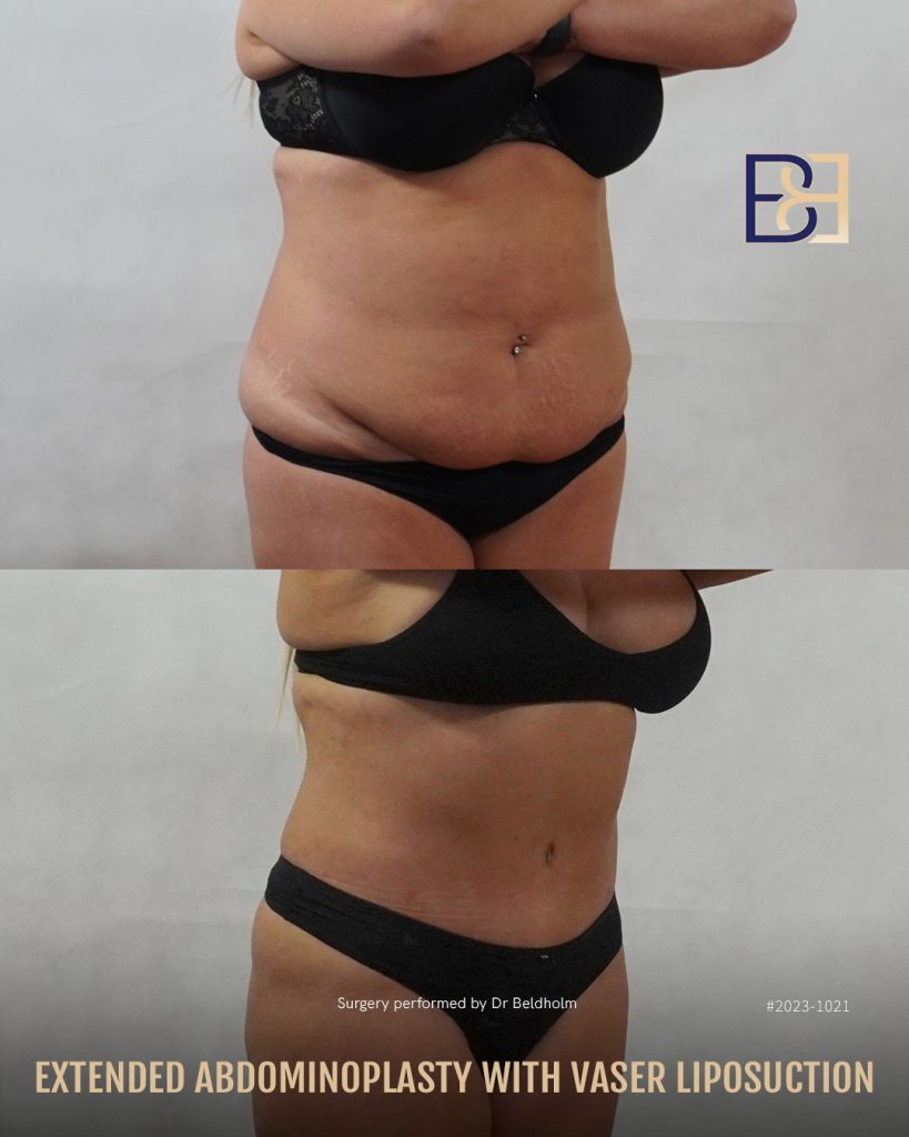 DrBB IG image Patient 2023 1021 Extended abdominoplasty with VASER liposuct Slide 2