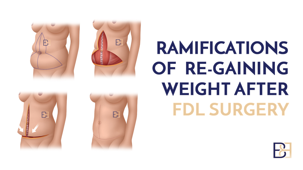 Ramifications of Re-Gaining Weight After FDL Surgery