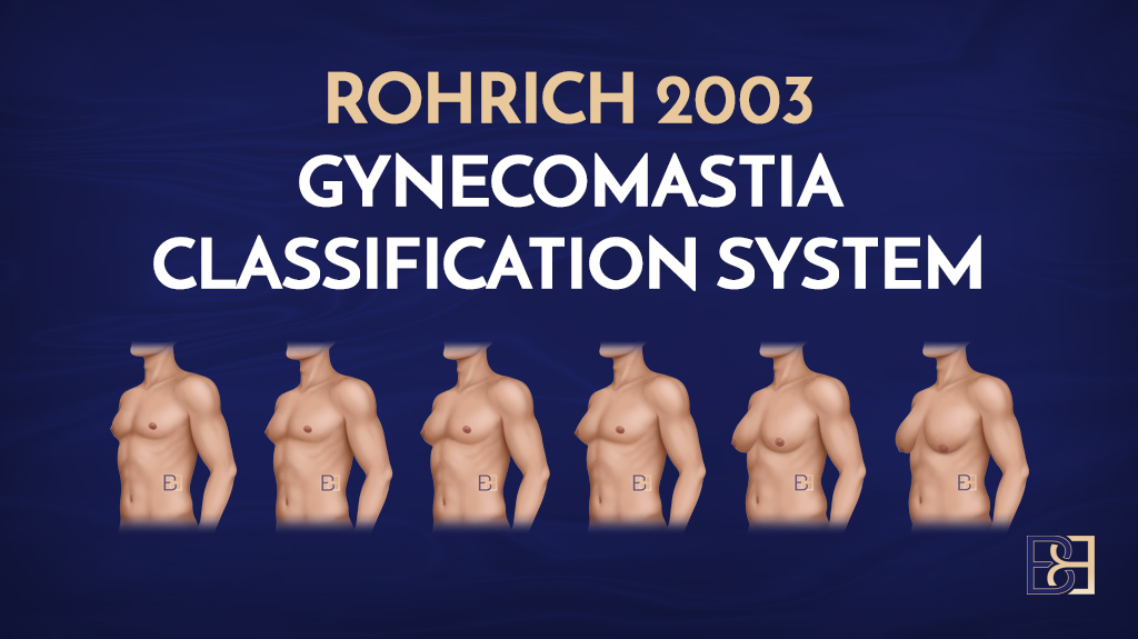 Rohrich Gynaecomastia Classification System (2003)