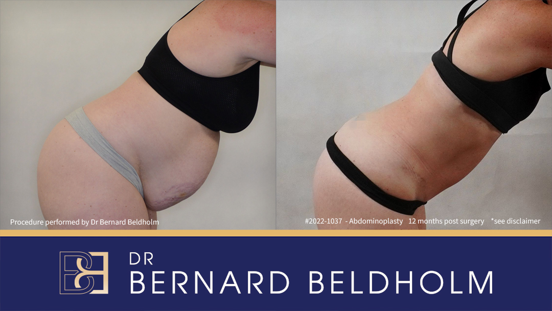 Full Abdominoplasty including VASER Liposuction (Patient 2022-1037) - Bend