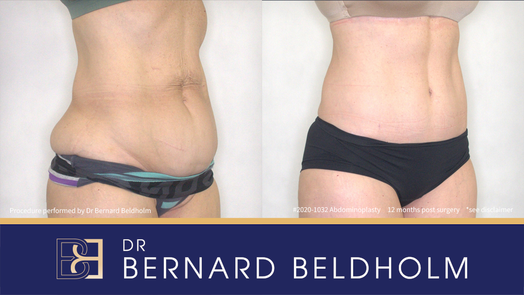 Abdominoplasty Post Weight Loss (Patient 2020-1032) - Left