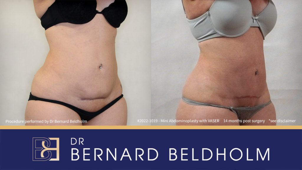 Mini Abdominoplasty Post Pregnancy Patient 2022-1019 - Left