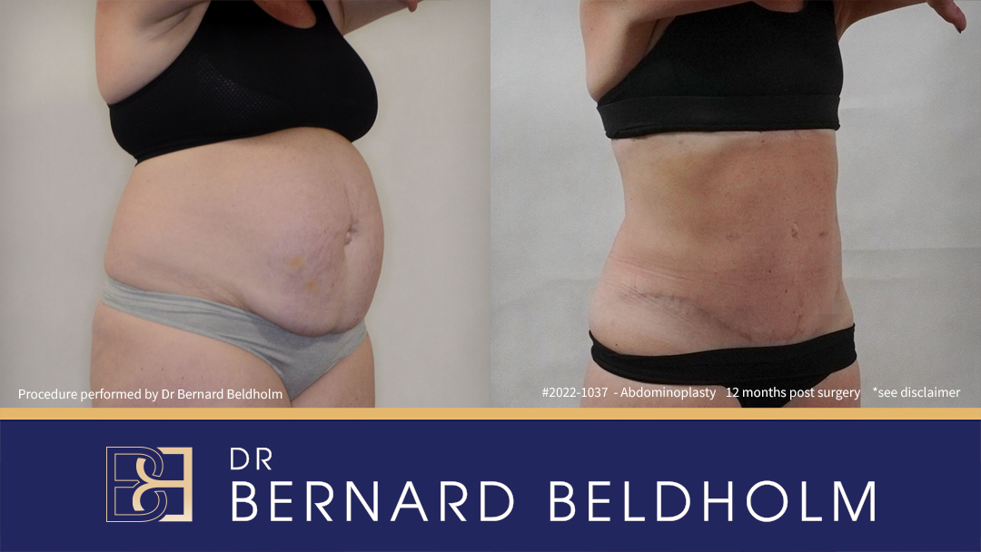 Full Abdominoplasty including VASER Liposuction (Patient 2022-1037) - Left