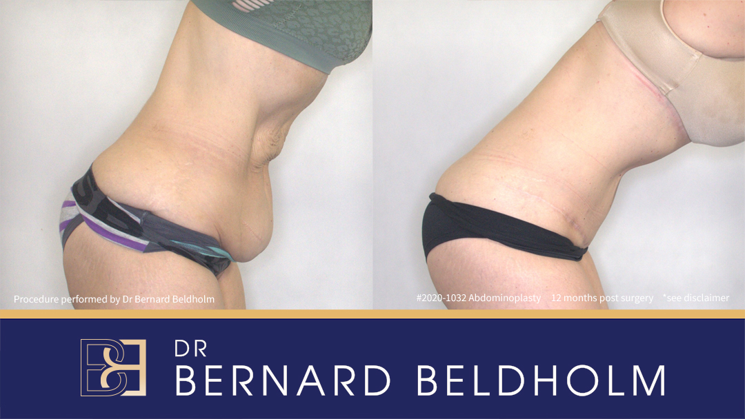 Abdominoplasty Post Weight Loss (Patient 2020-1032) - Bend