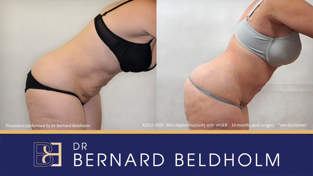 Mini Abdominoplasty Post Pregnancy Patient 2018-1006 - Bend