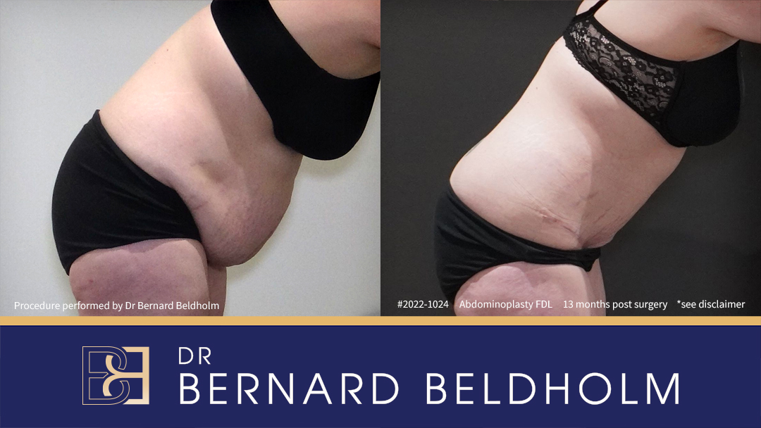 Fleur de Lis Abdominoplasty Post Weight Loss (Patient 2022-1024) - Bend