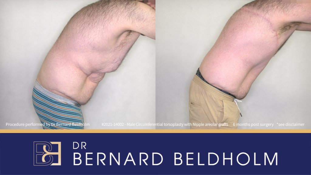 Male Circumferential Torsoplasty (Upper Thoracic Lift) with Nipple Areolar Grafts (Patient 2021-14002) 6 Months Post Surgery - Bend