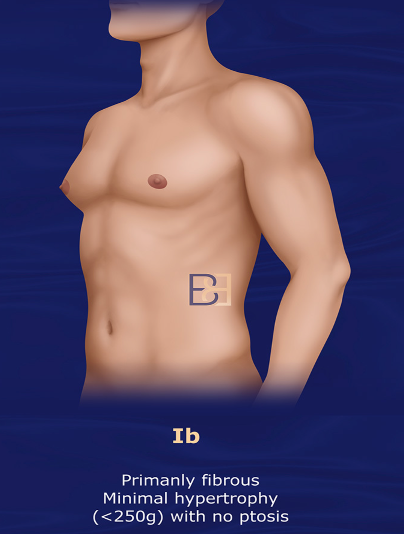 Grade Ib | Rohrich 2003 Gynaecomastia Classification System | Dr Beldholm