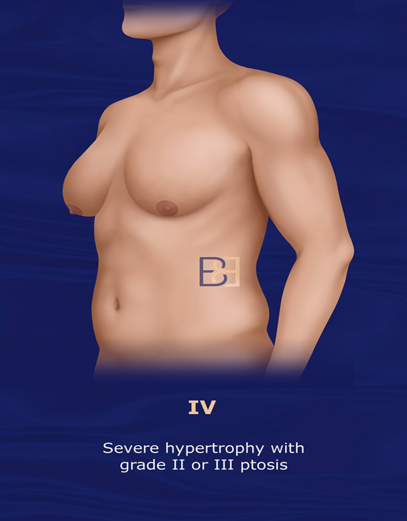 Grade IV | Rohrich 2003 Gynaecomastia Classification System | Dr Beldholm