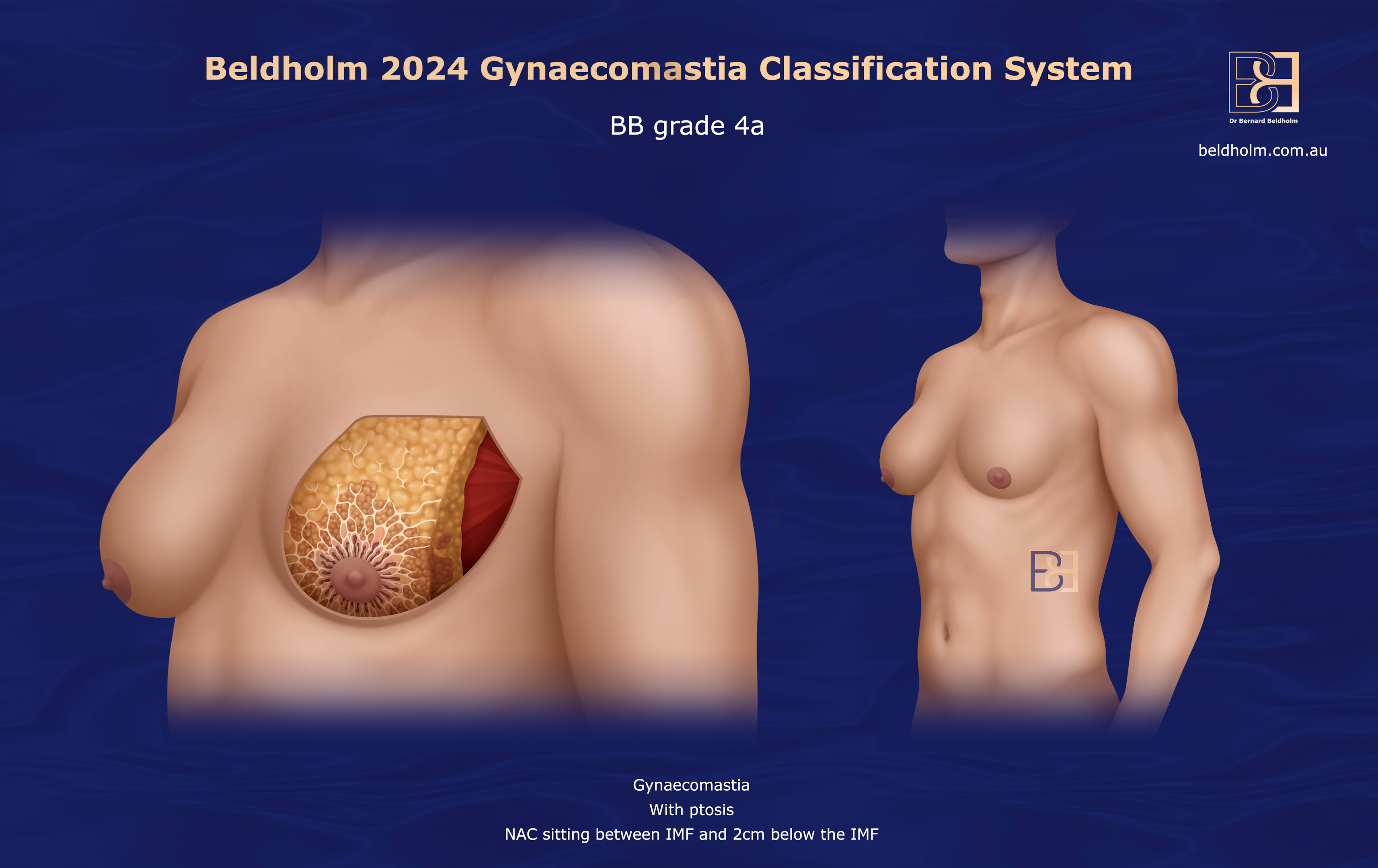 BB Grade 4a gynaecomastia | Dr Beldholm