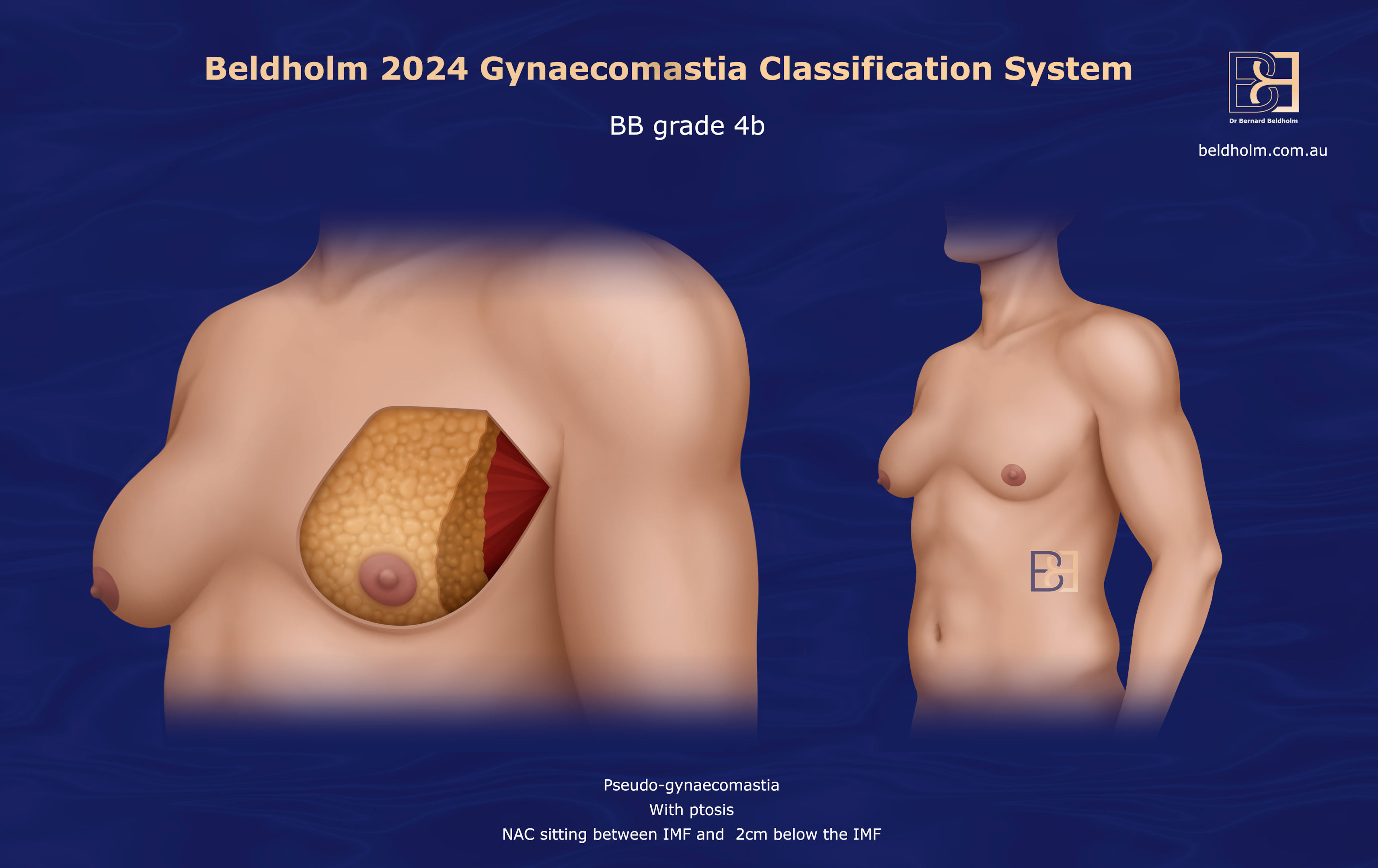 BB Grade 4b gynaecomastia | Dr Beldholm