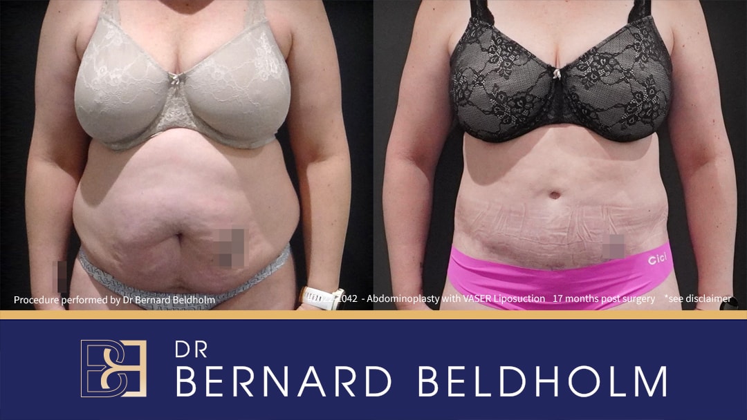 Extended Abdominoplasty with VASER liposuction | Dr Beldholm