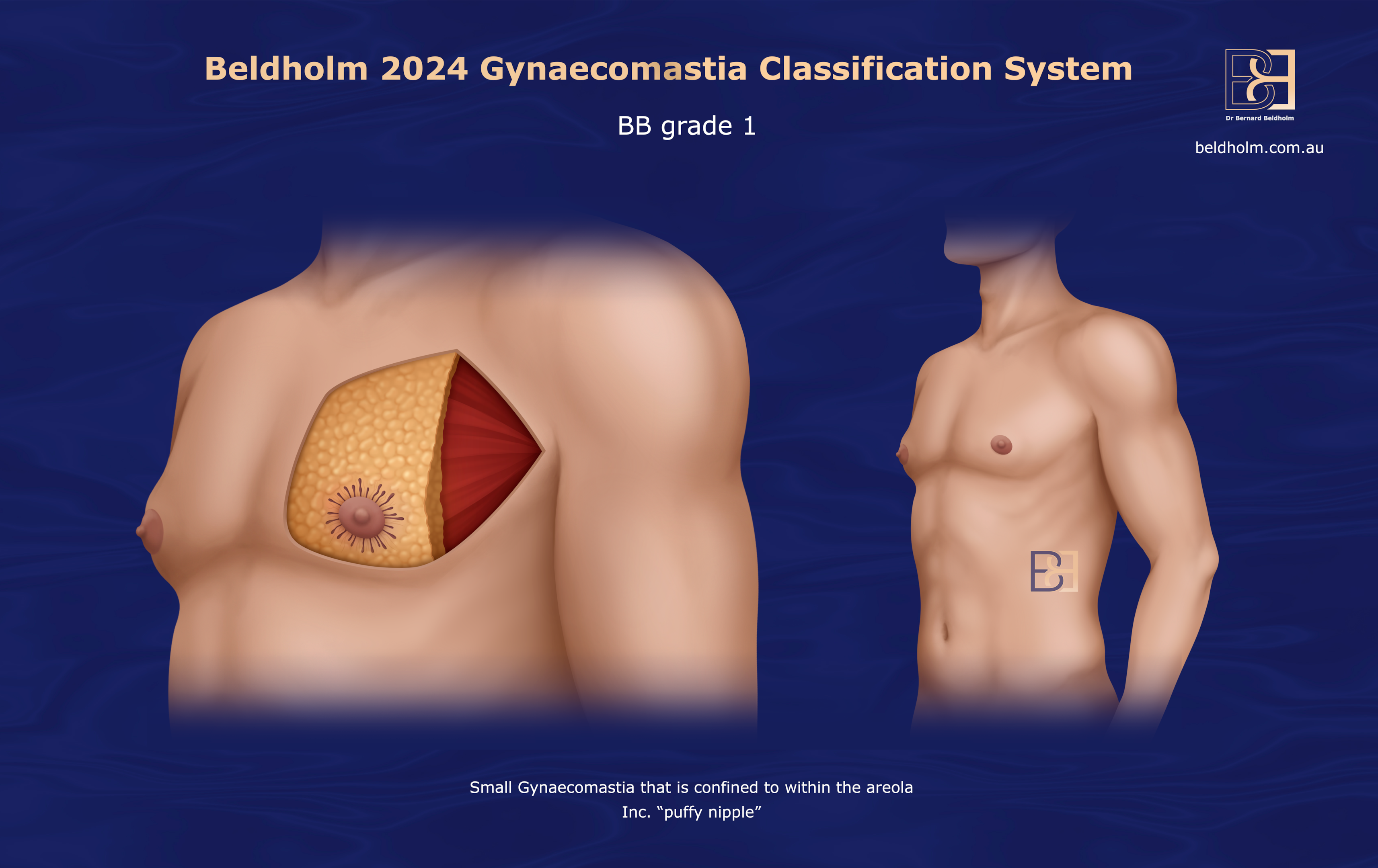 BB Grade 1 gynaecomastia | Dr Beldholm