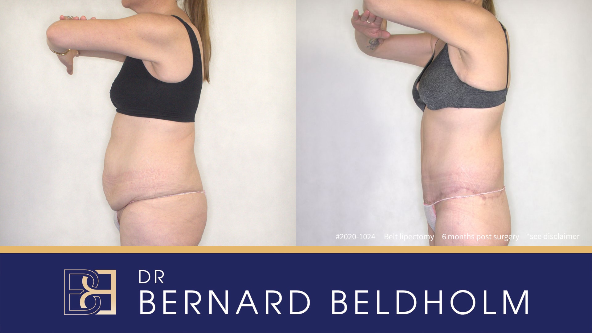 Abdominoplasty tummy tuck | Dr Beldholm