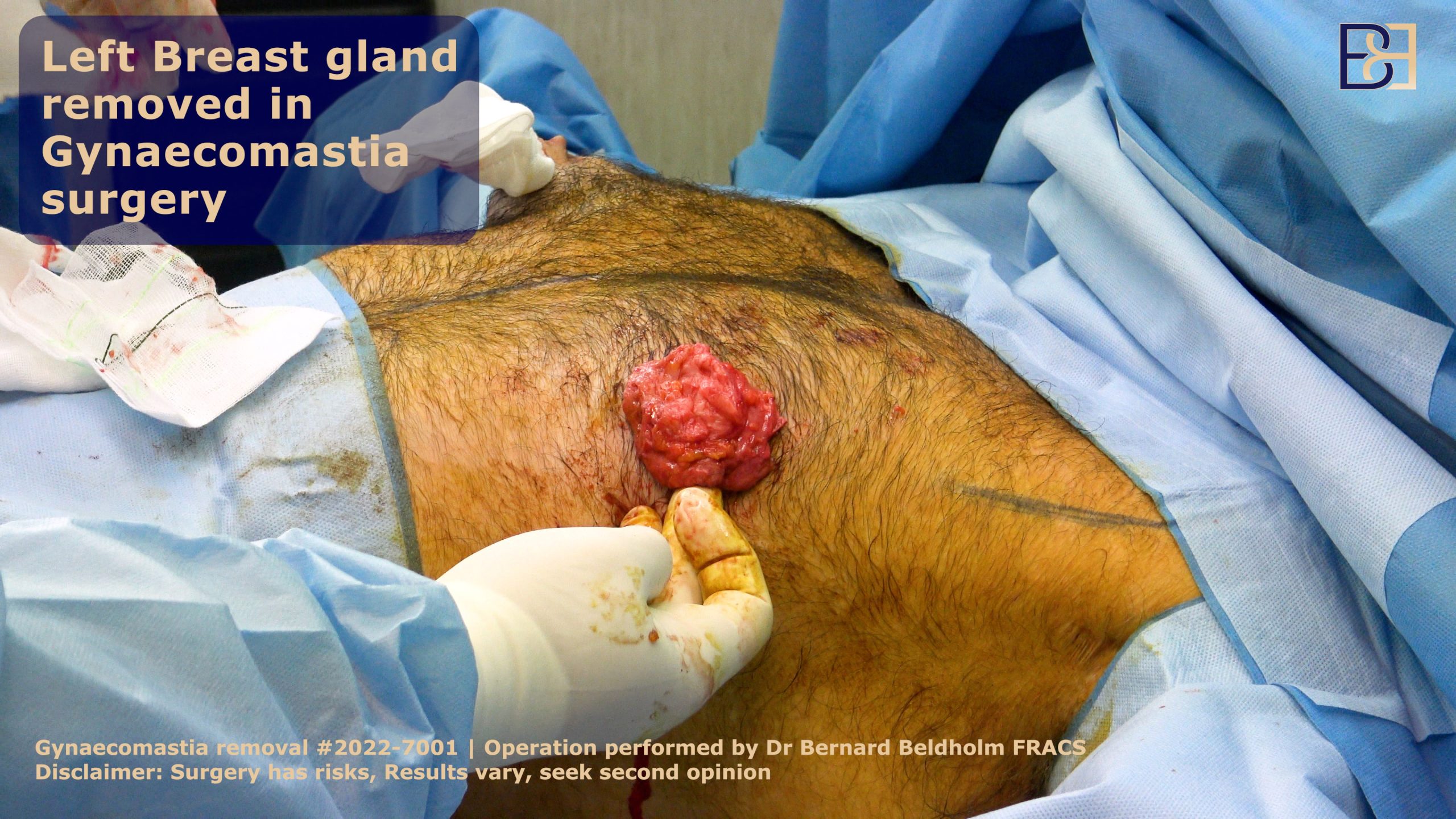 Gynaecomastia excision performed in operating room to reduce breast volume  / Sydney, Australia | Dr Beldholm