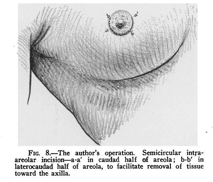 male breast reduction