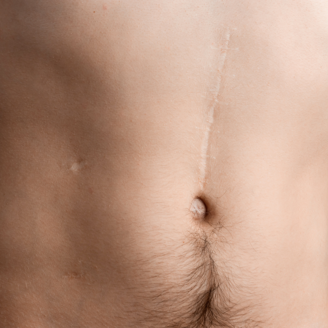 tummy tuck  after extensive weight loss