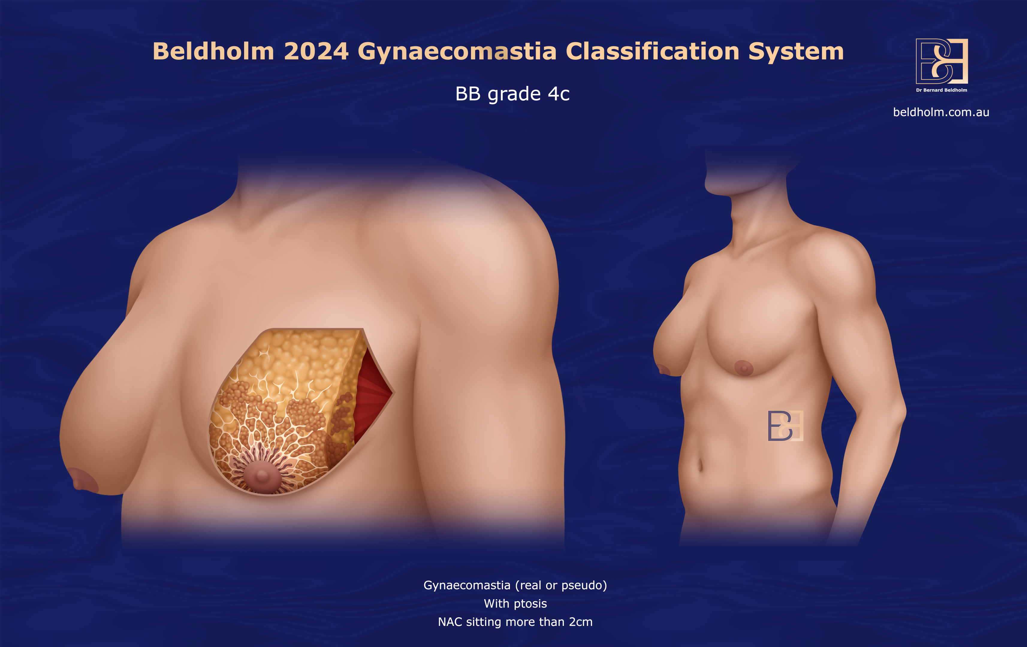 BB Grade 4c gynaecomastia | Dr Beldholm