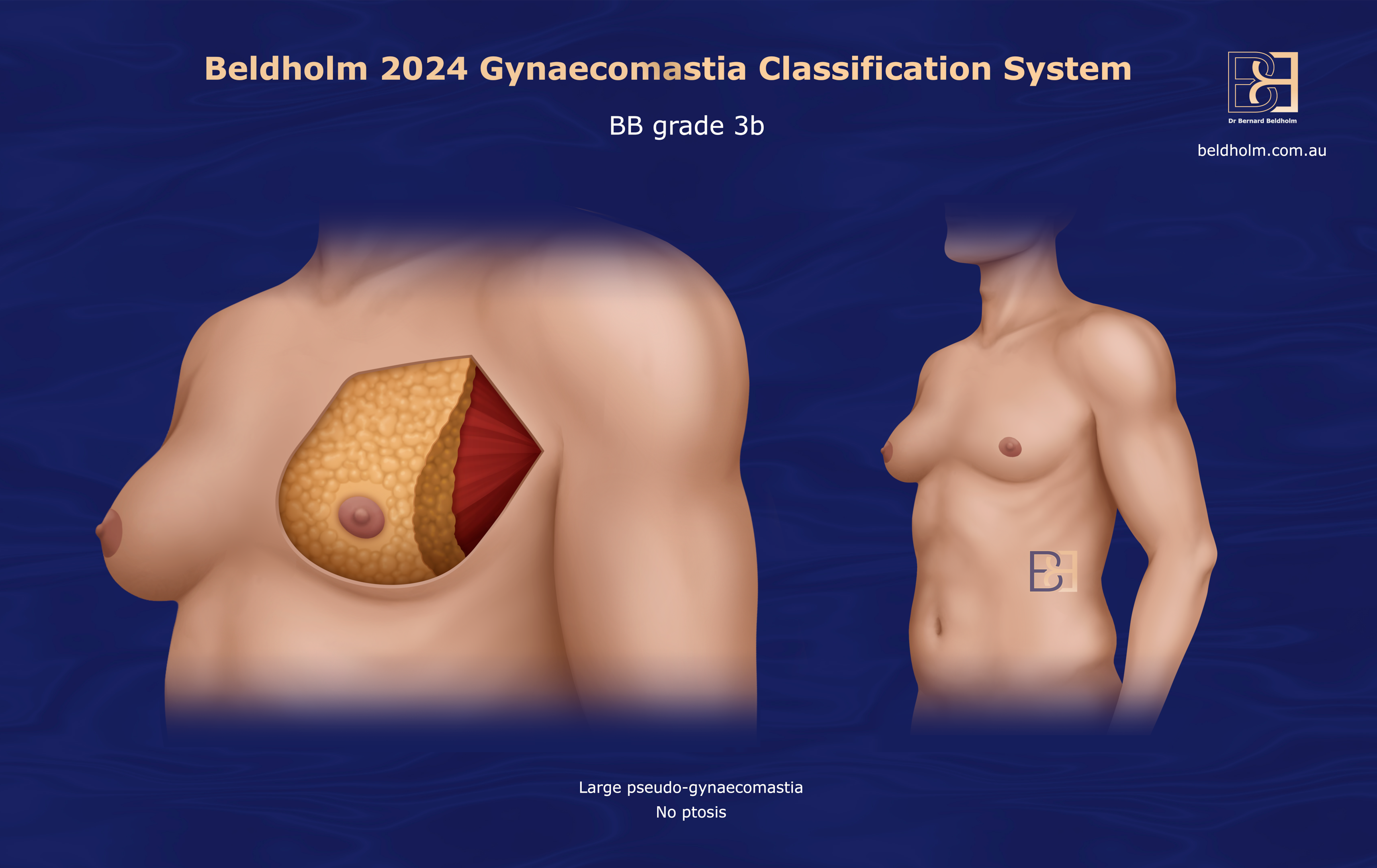 BB Grade 3b gynaecomastia | Dr Beldholm